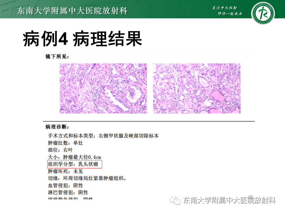 影像PPT - 【PPT】甲状腺乳头状癌的影像诊断-33