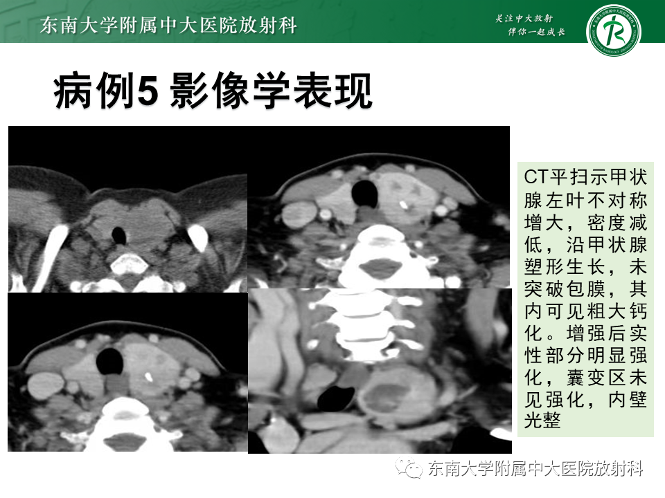 影像PPT - 【PPT】甲状腺乳头状癌的影像诊断-37