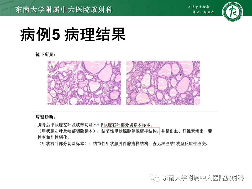 影像PPT - 【PPT】甲状腺乳头状癌的影像诊断-38