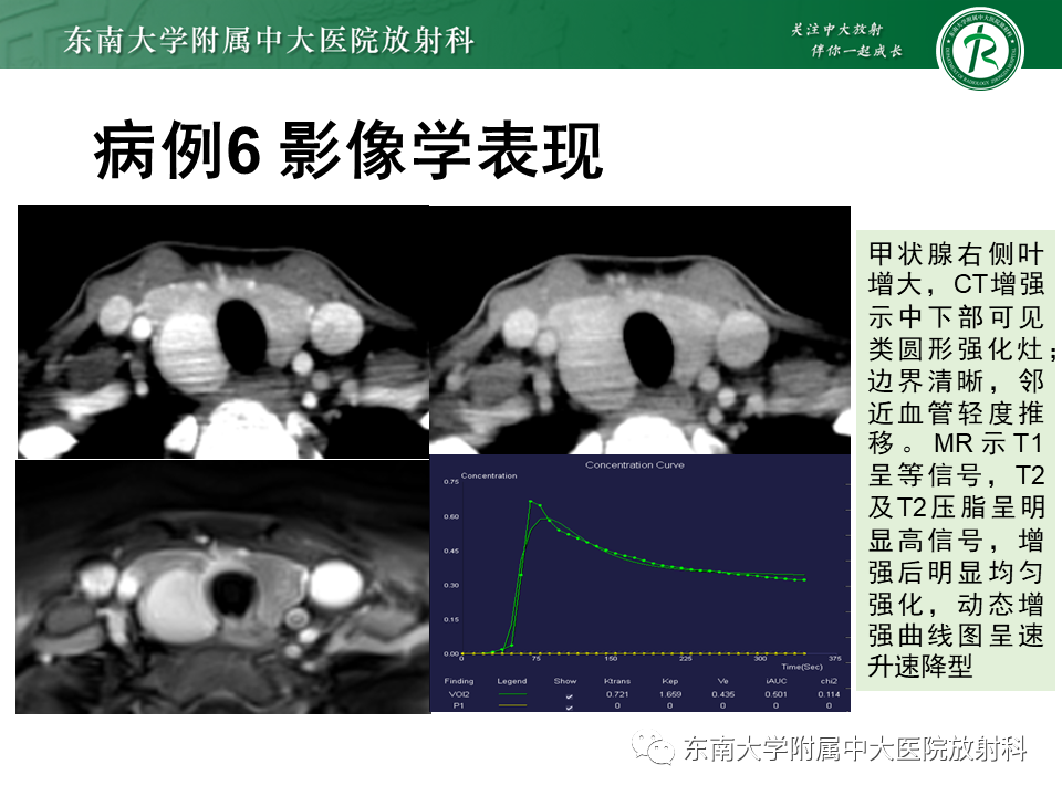 影像PPT - 【PPT】甲状腺乳头状癌的影像诊断-40