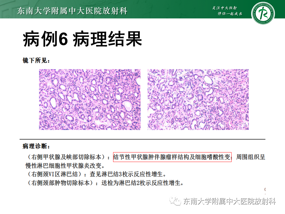 影像PPT - 【PPT】甲状腺乳头状癌的影像诊断-41