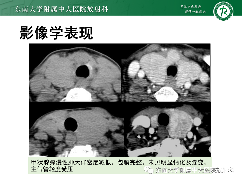 影像PPT - 【PPT】甲状腺乳头状癌的影像诊断-46
