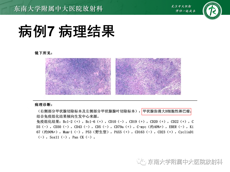 影像PPT - 【PPT】甲状腺乳头状癌的影像诊断-50