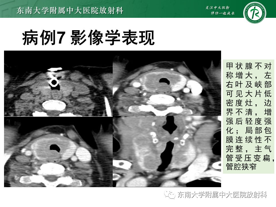 影像PPT - 【PPT】甲状腺乳头状癌的影像诊断-49