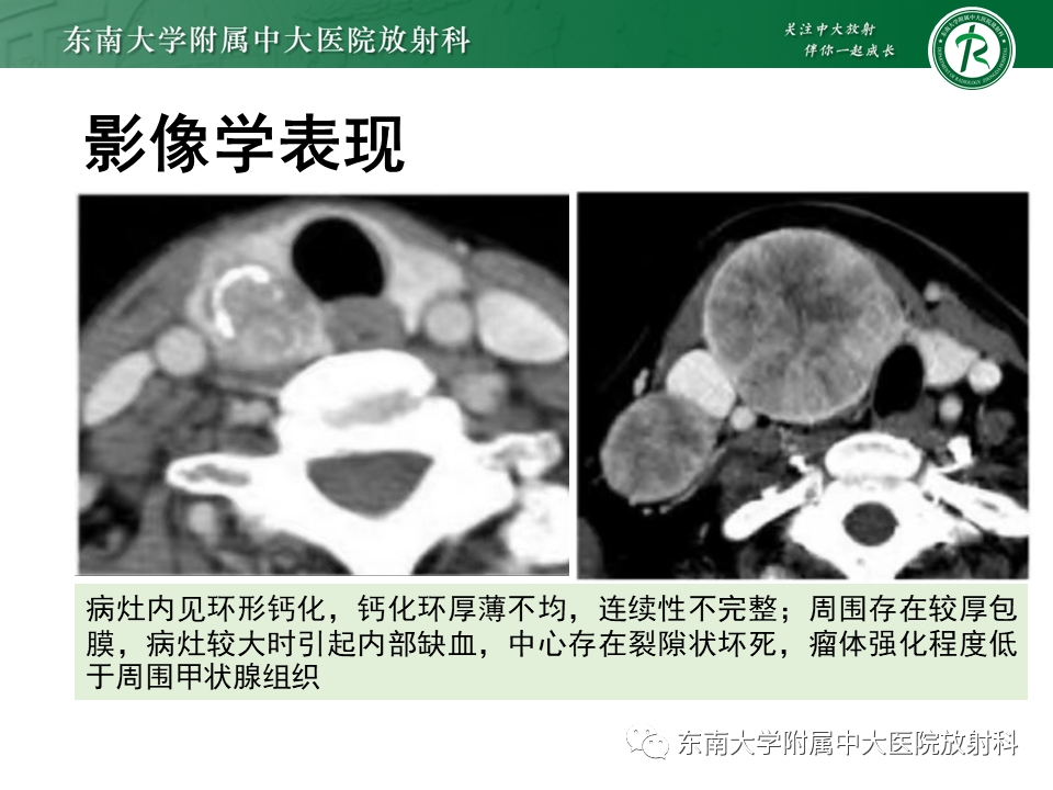 影像PPT - 【PPT】甲状腺乳头状癌的影像诊断-1