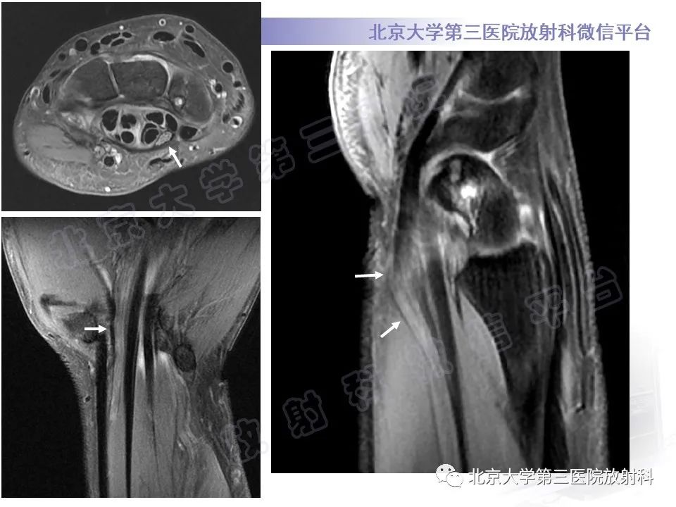 影像PPT - 【PPT】腕管综合征-4