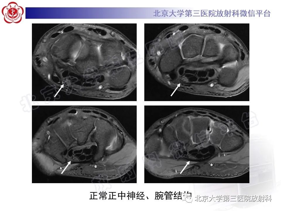 影像PPT - 【PPT】腕管综合征-15