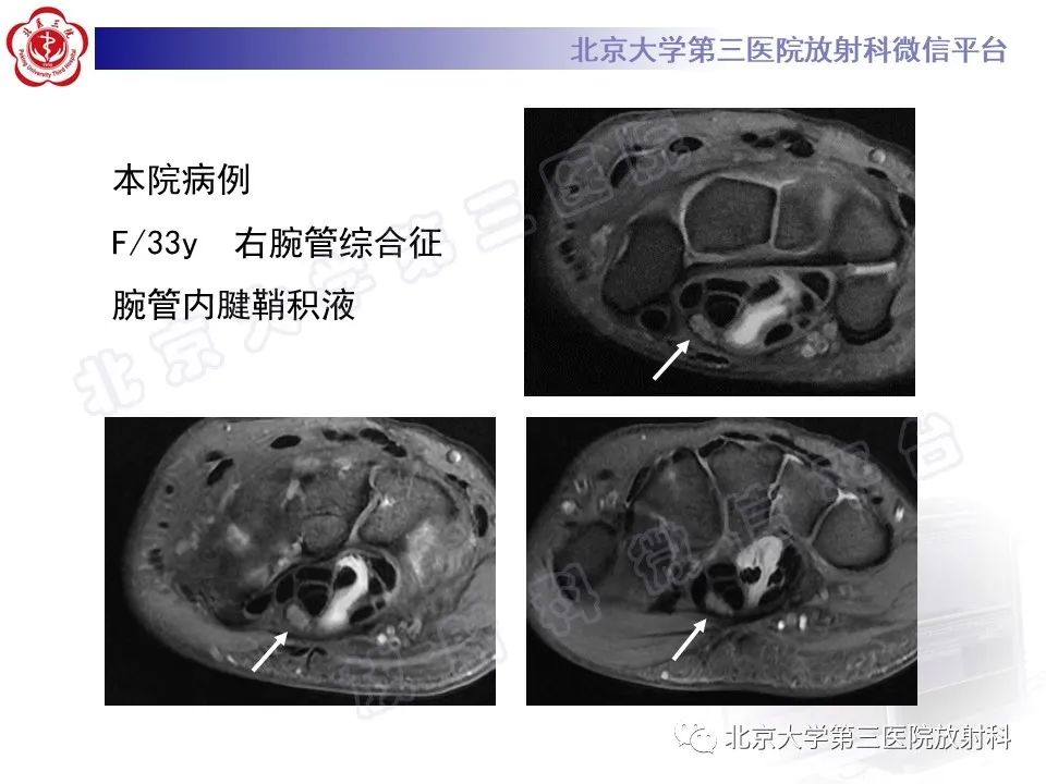 影像PPT - 【PPT】腕管综合征-21