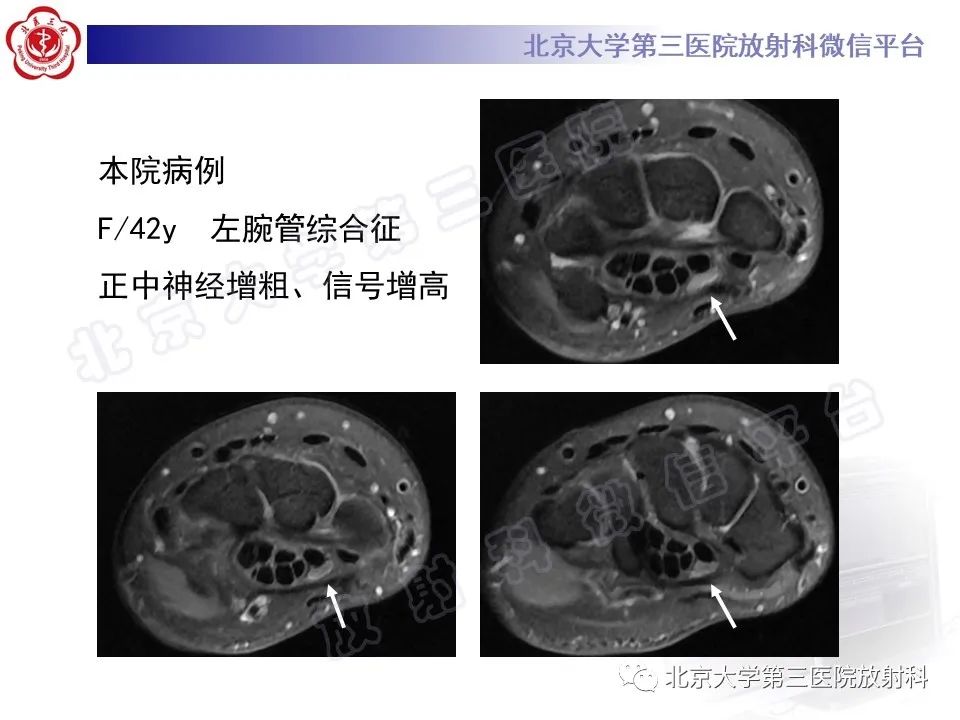 影像PPT - 【PPT】腕管综合征-2