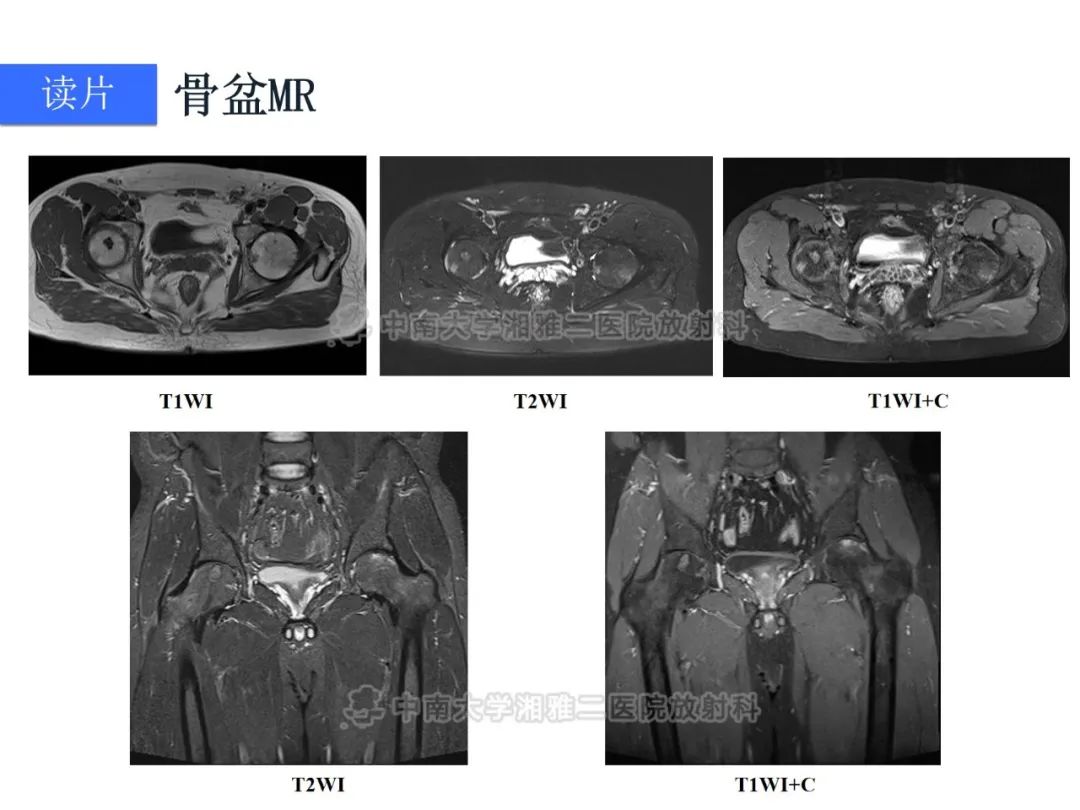 影像PPT - 【病例】磷酸盐尿性间叶性肿瘤1例影像学诊断思路-5
