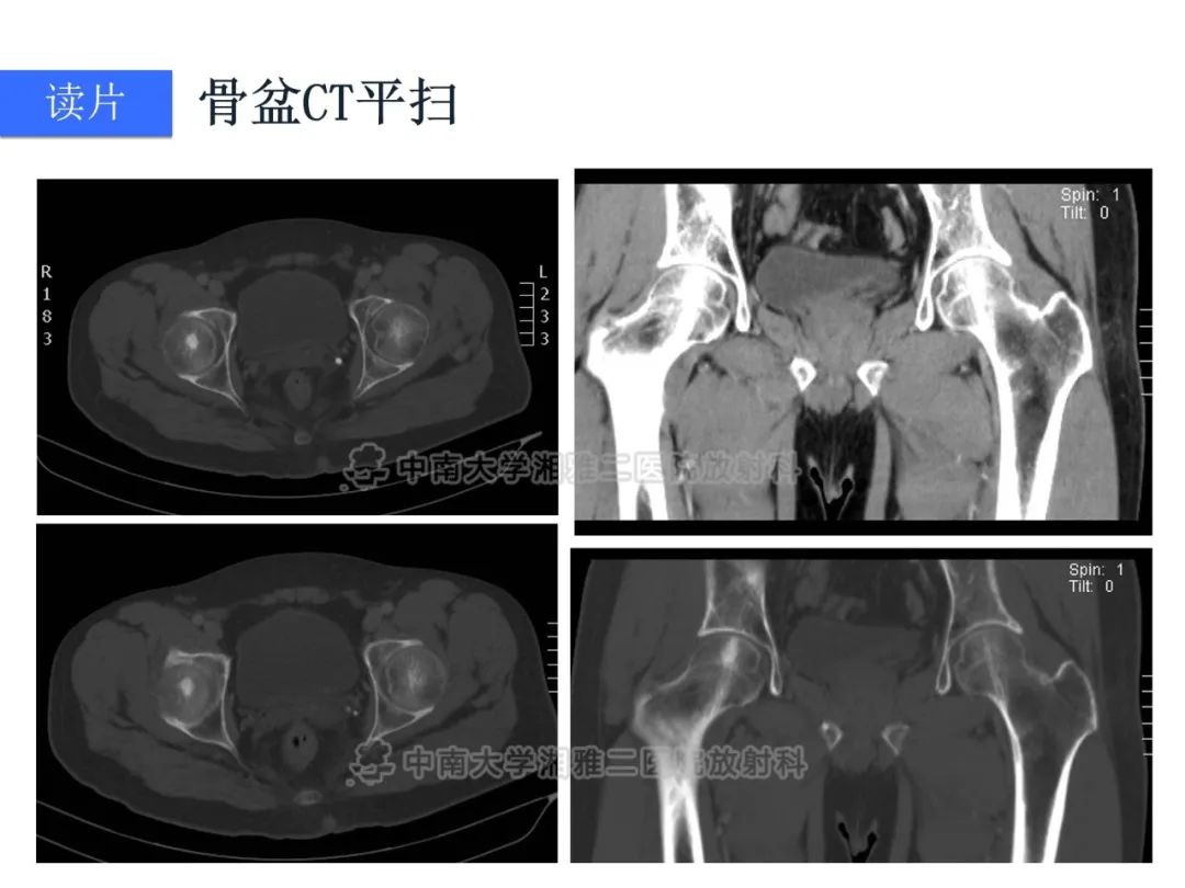 影像PPT - 【病例】磷酸盐尿性间叶性肿瘤1例影像学诊断思路-4