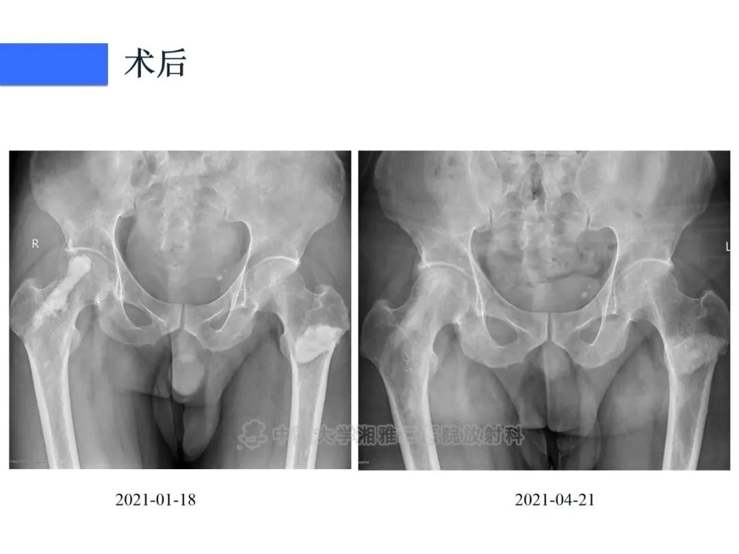 影像PPT - 【病例】磷酸盐尿性间叶性肿瘤1例影像学诊断思路-9