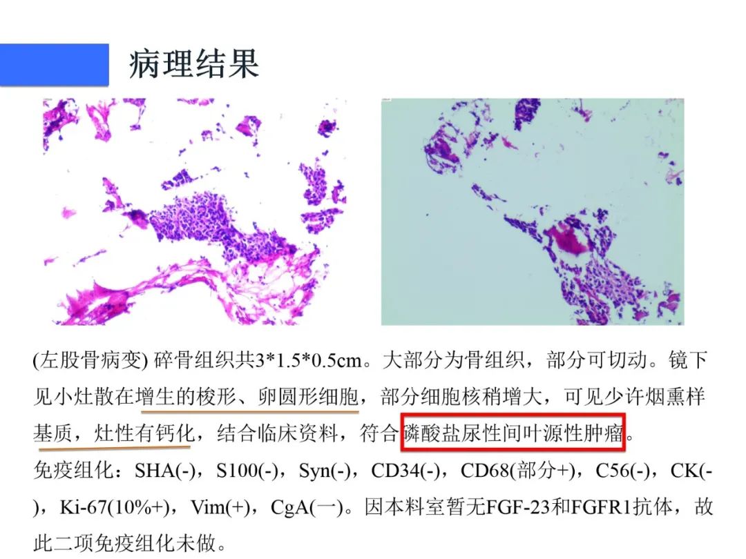 影像PPT - 【病例】磷酸盐尿性间叶性肿瘤1例影像学诊断思路-10