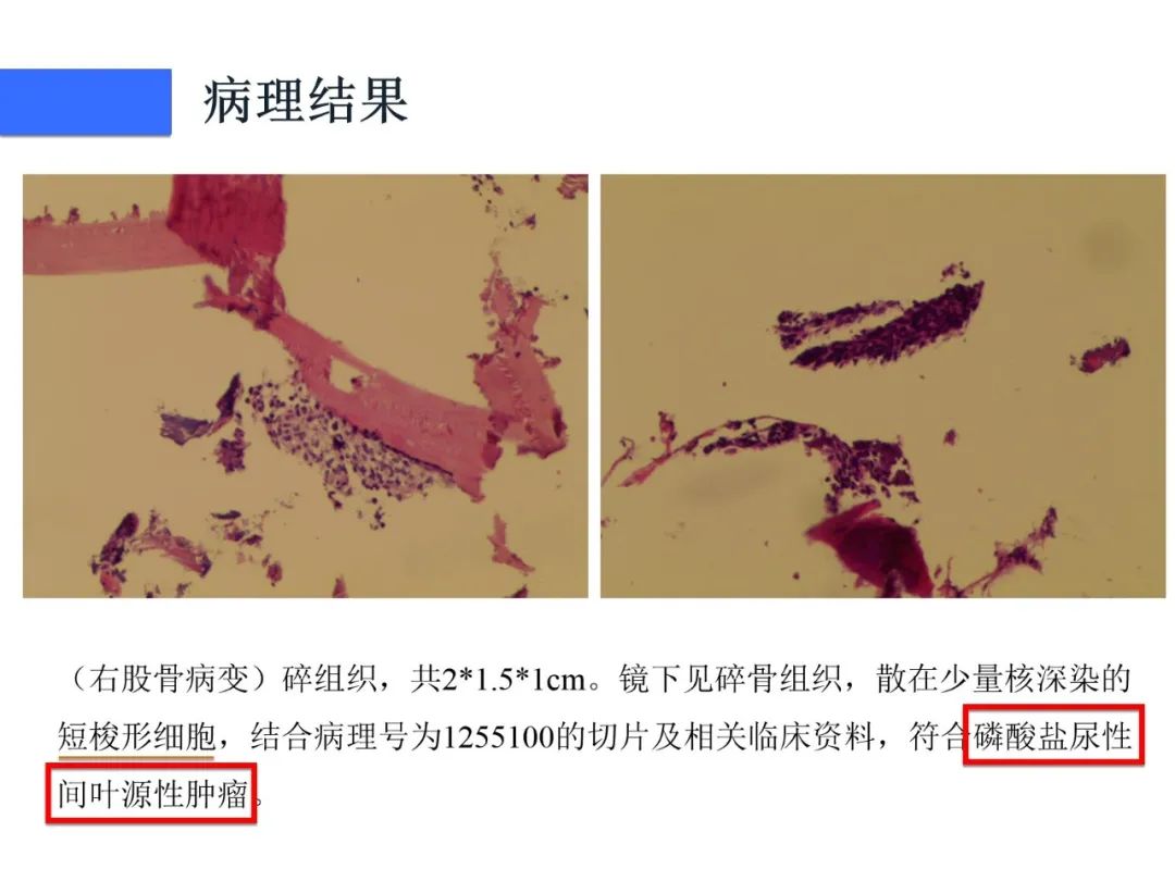 影像PPT - 【病例】磷酸盐尿性间叶性肿瘤1例影像学诊断思路-11