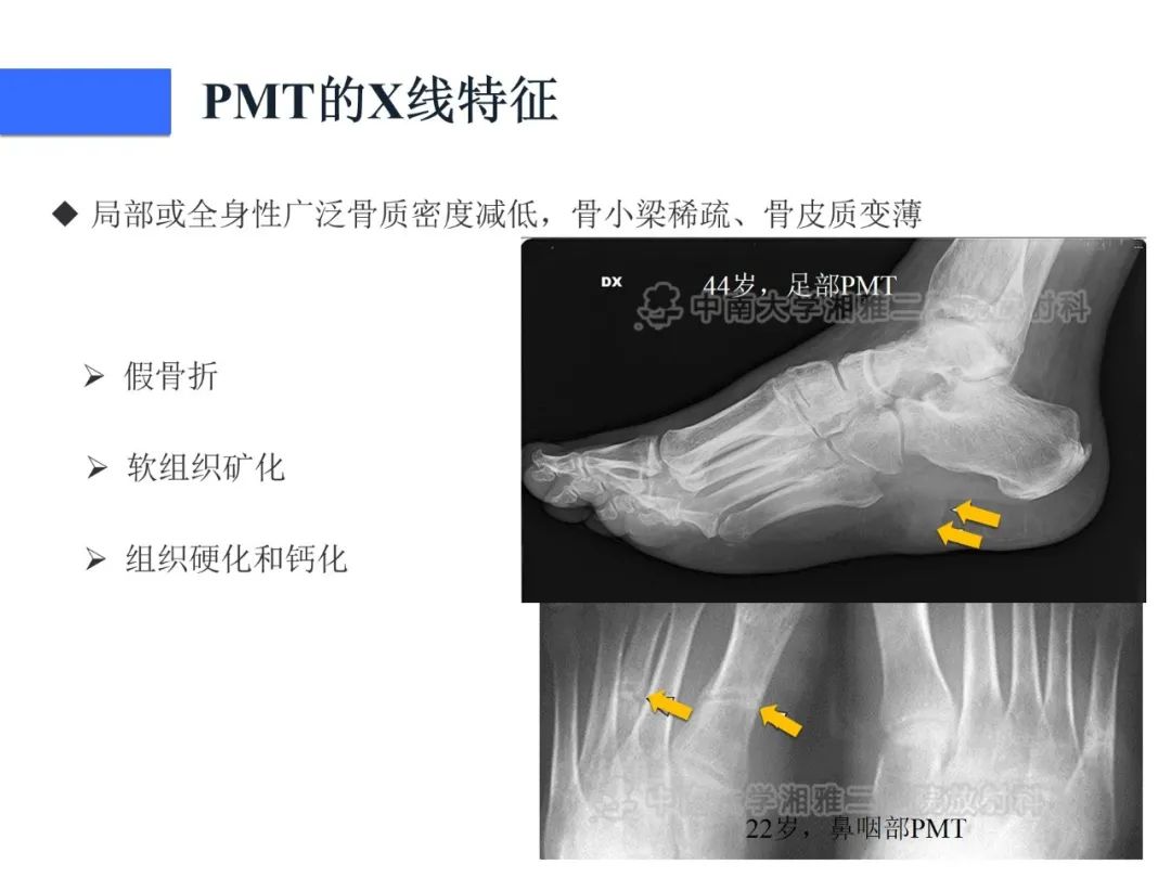 影像PPT - 【病例】磷酸盐尿性间叶性肿瘤1例影像学诊断思路-17