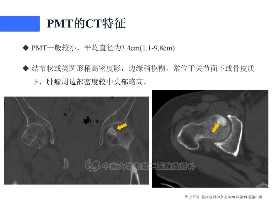 影像PPT - 【病例】磷酸盐尿性间叶性肿瘤1例影像学诊断思路-19