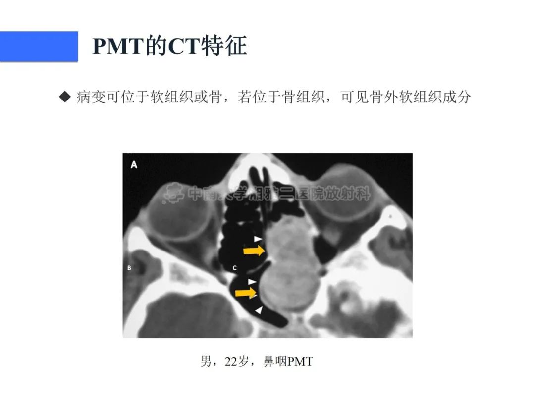 影像PPT - 【病例】磷酸盐尿性间叶性肿瘤1例影像学诊断思路-20