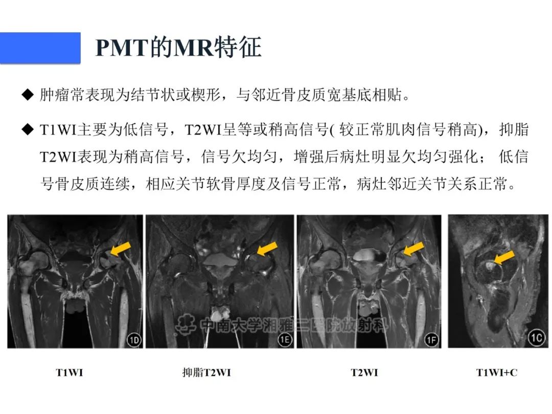 影像PPT - 【病例】磷酸盐尿性间叶性肿瘤1例影像学诊断思路-21