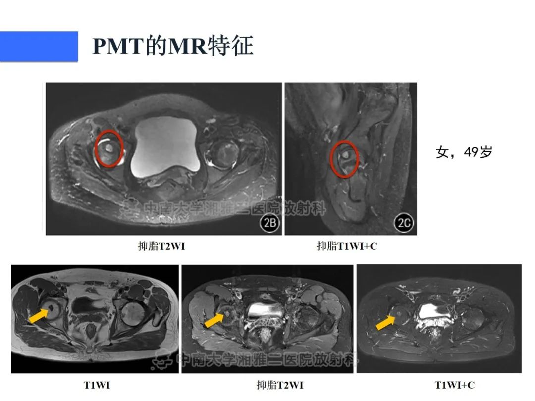 影像PPT - 【病例】磷酸盐尿性间叶性肿瘤1例影像学诊断思路-22