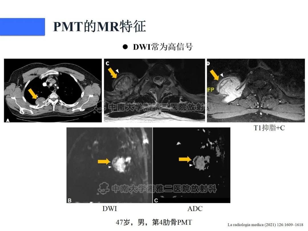 影像PPT - 【病例】磷酸盐尿性间叶性肿瘤1例影像学诊断思路-23
