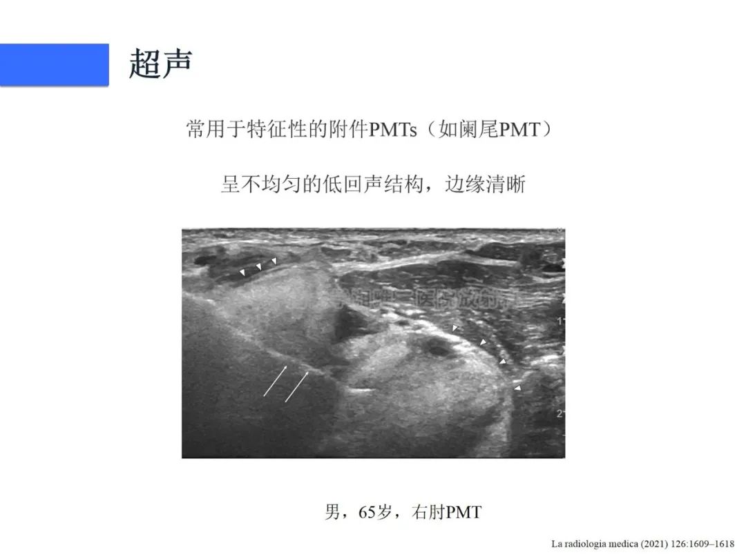 影像PPT - 【病例】磷酸盐尿性间叶性肿瘤1例影像学诊断思路-24