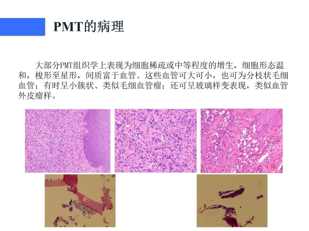 影像PPT - 【病例】磷酸盐尿性间叶性肿瘤1例影像学诊断思路-27