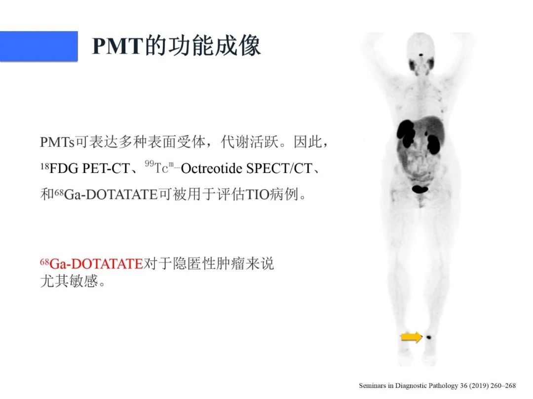 影像PPT - 【病例】磷酸盐尿性间叶性肿瘤1例影像学诊断思路-25