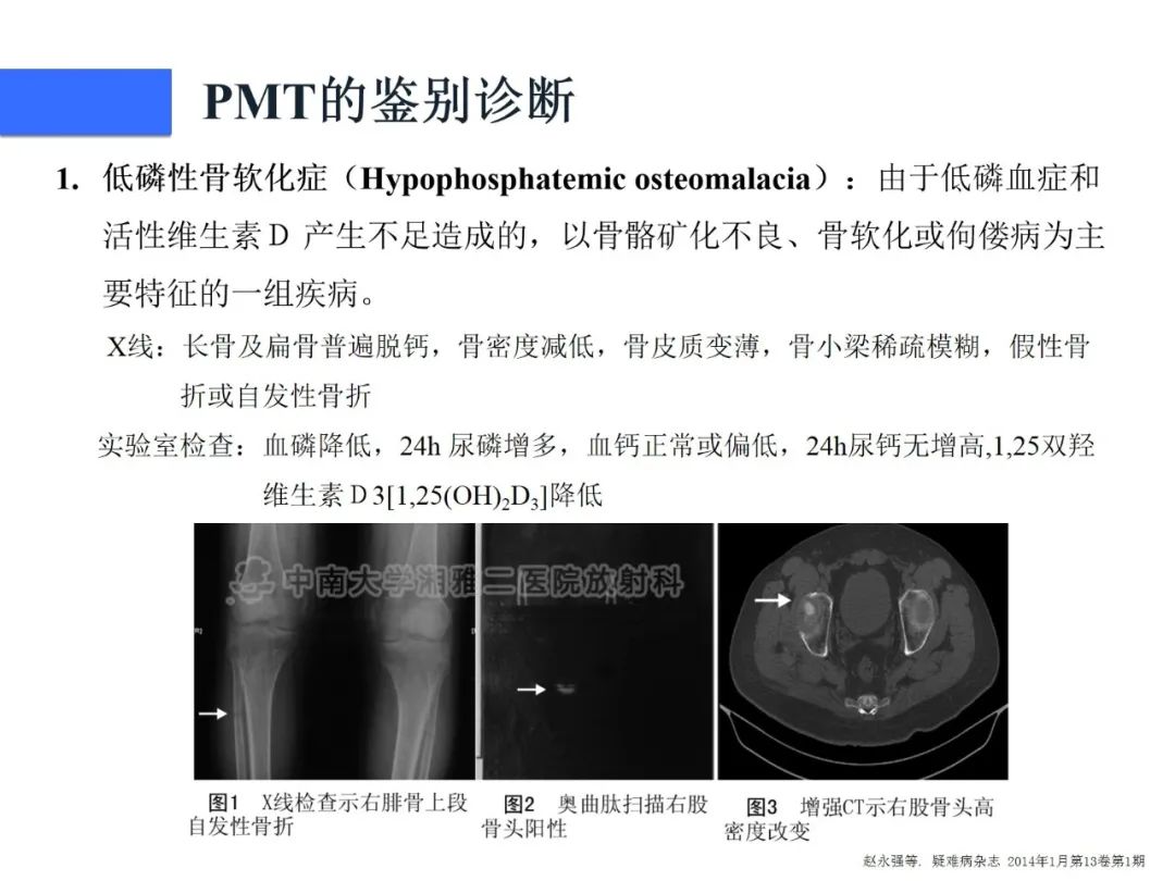 影像PPT - 【病例】磷酸盐尿性间叶性肿瘤1例影像学诊断思路-30