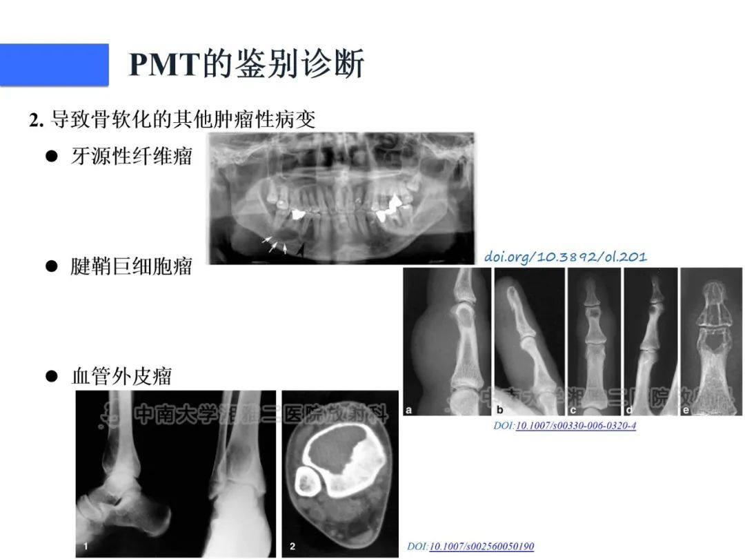 影像PPT - 【病例】磷酸盐尿性间叶性肿瘤1例影像学诊断思路-31