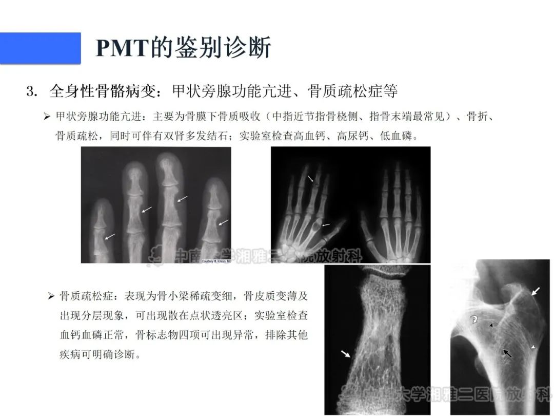 影像PPT - 【病例】磷酸盐尿性间叶性肿瘤1例影像学诊断思路-32