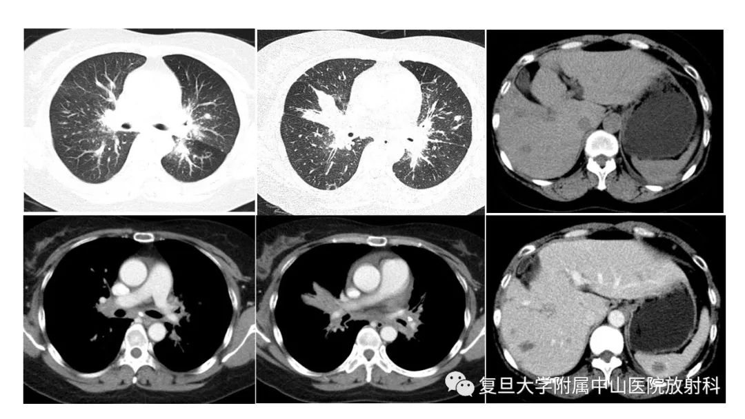 影像PPT - 【病例】结节病2例影像-3