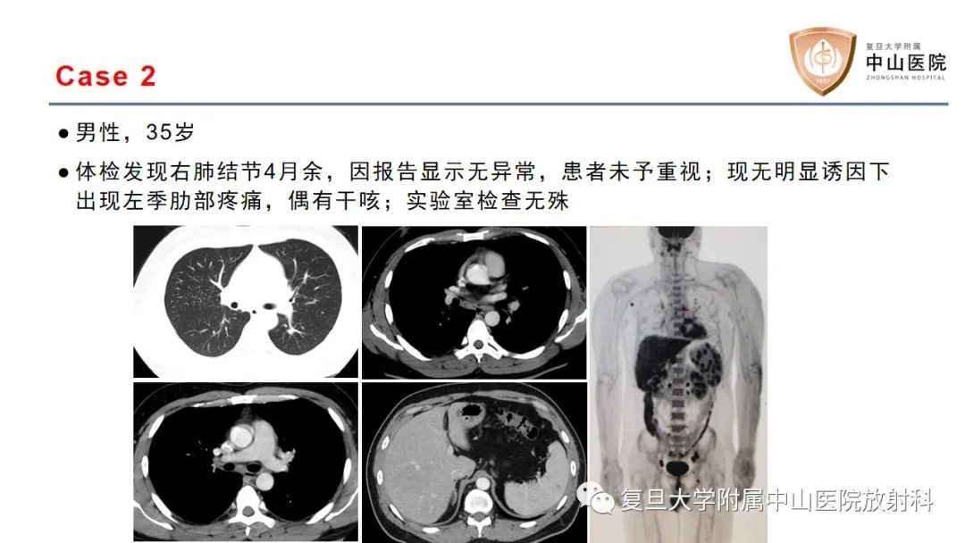 影像PPT - 【病例】结节病2例影像-4