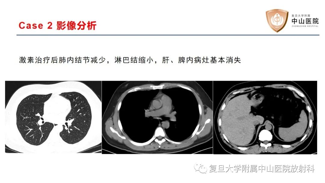 影像PPT - 【病例】结节病2例影像-13