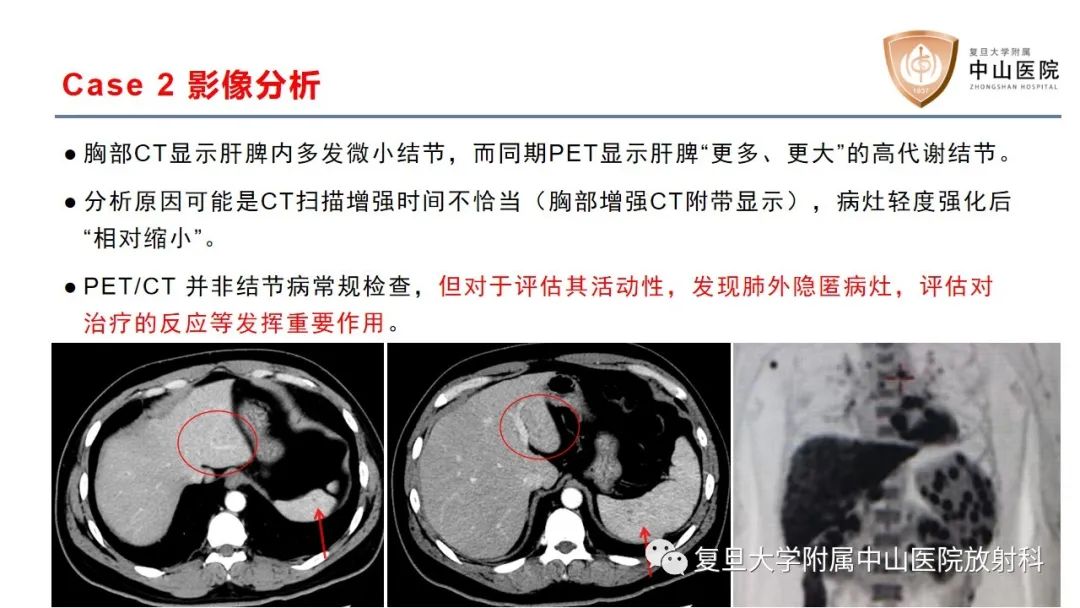 影像PPT - 【病例】结节病2例影像-12