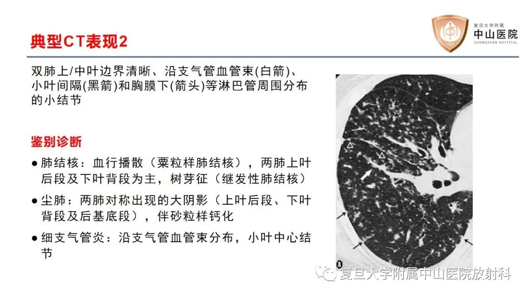 影像PPT - 【病例】结节病2例影像-15