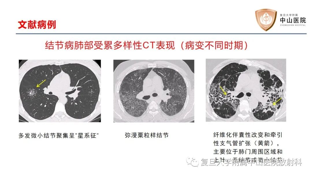 影像PPT - 【病例】结节病2例影像-16