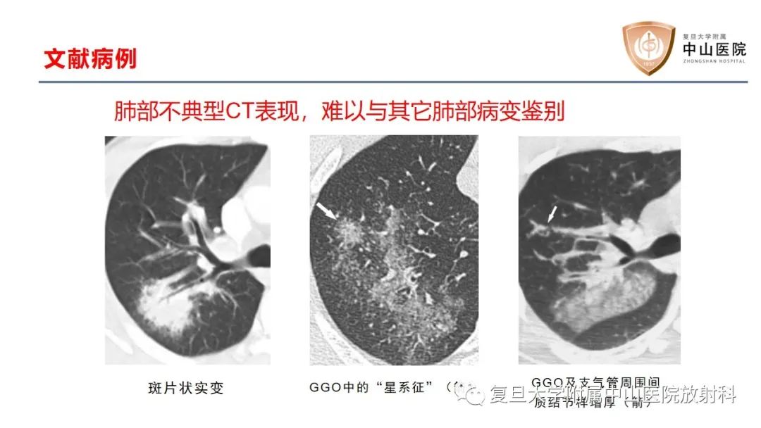 影像PPT - 【病例】结节病2例影像-17