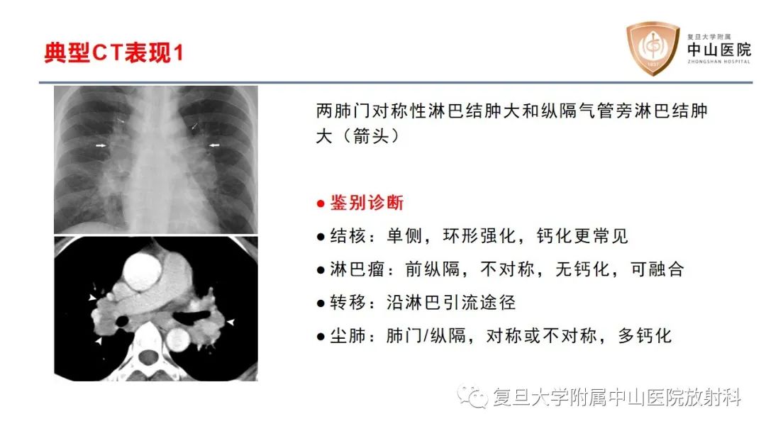 影像PPT - 【病例】结节病2例影像-14