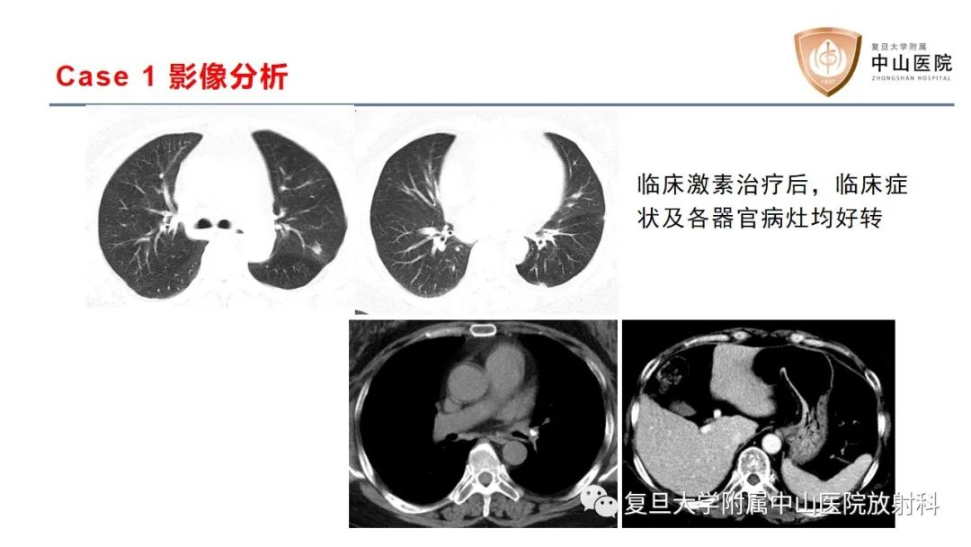 影像PPT - 【病例】结节病2例影像-11