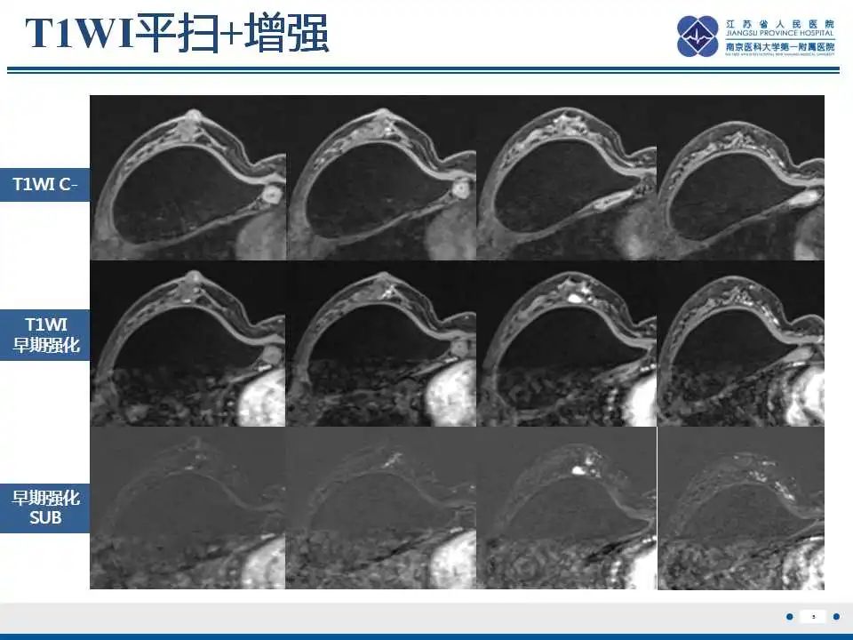 影像PPT - 乳腺疾病中的“扁面条征”-8 影像PPT - 乳腺疾病中的“扁面条征”-8