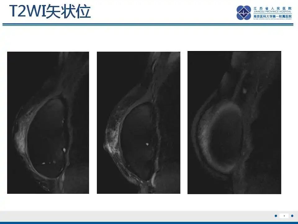 影像PPT - 乳腺疾病中的“扁面条征”-7 影像PPT - 乳腺疾病中的“扁面条征”-7