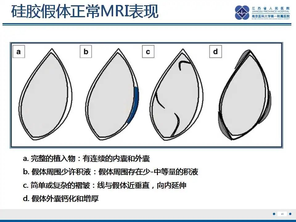 影像PPT - 乳腺疾病中的“扁面条征”-26 影像PPT - 乳腺疾病中的“扁面条征”-26