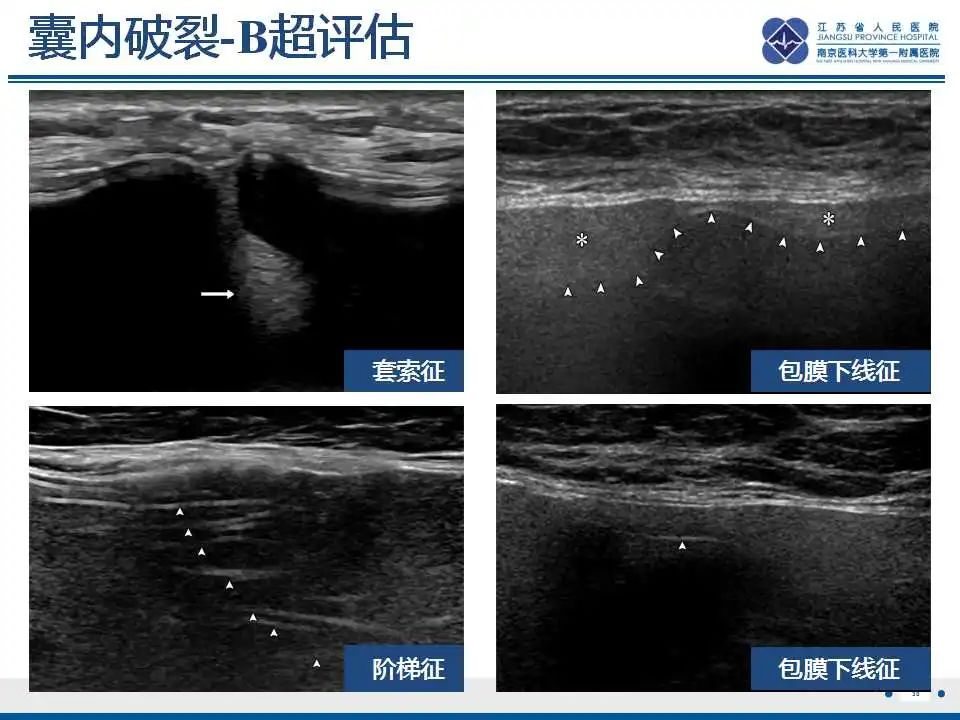 影像PPT - 乳腺疾病中的“扁面条征”-33 影像PPT - 乳腺疾病中的“扁面条征”-33
