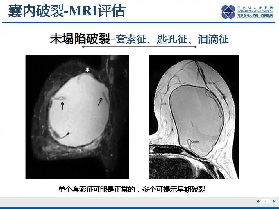 影像PPT - 乳腺疾病中的“扁面条征”-35 影像PPT - 乳腺疾病中的“扁面条征”-35