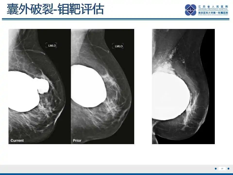 影像PPT - 乳腺疾病中的“扁面条征”-40 影像PPT - 乳腺疾病中的“扁面条征”-40
