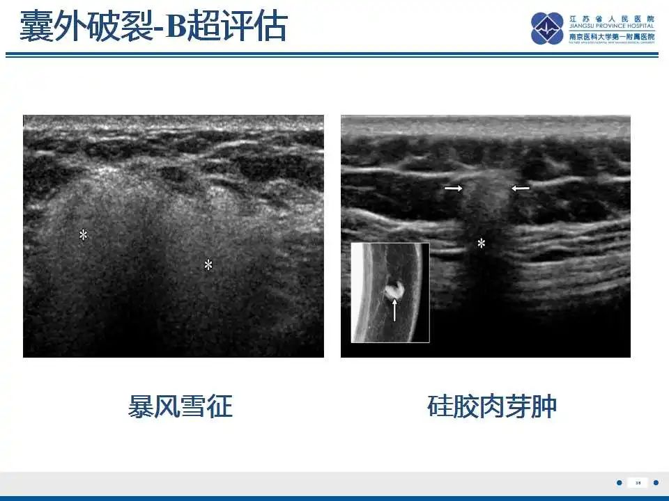影像PPT - 乳腺疾病中的“扁面条征”-41 影像PPT - 乳腺疾病中的“扁面条征”-41