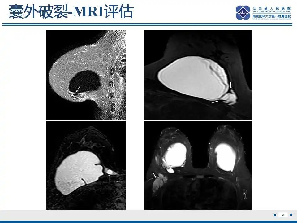 影像PPT - 乳腺疾病中的“扁面条征”-42 影像PPT - 乳腺疾病中的“扁面条征”-42