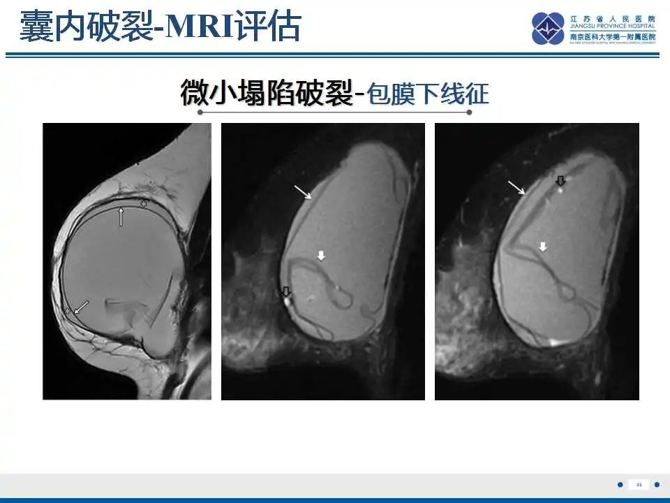 影像PPT - 乳腺疾病中的“扁面条征”-1 影像PPT - 乳腺疾病中的“扁面条征”-1
