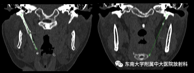 影像PPT - 【PPT】茎突综合征-5