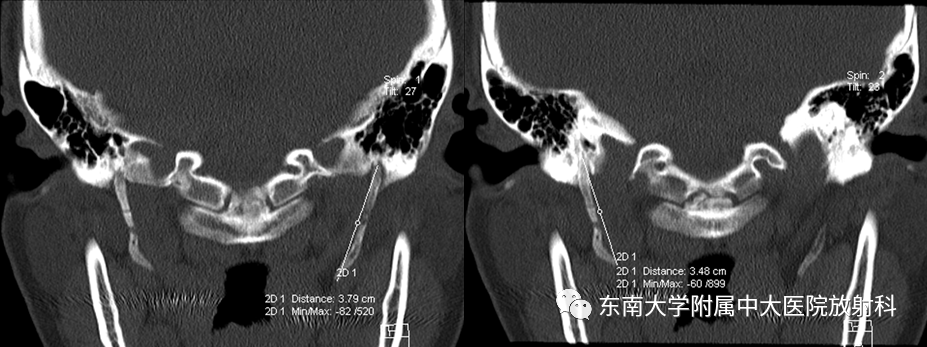 影像PPT - 【PPT】茎突综合征-2